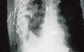 x-ray view of large effusion in a patient associated with HPS