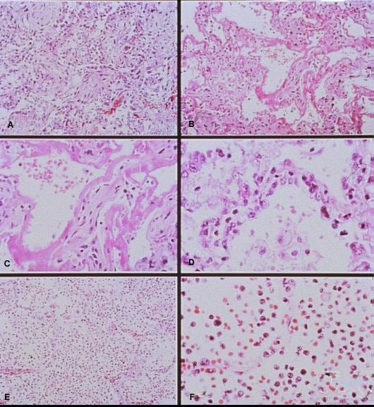 less commonly seen histopathological features in cases of HPS