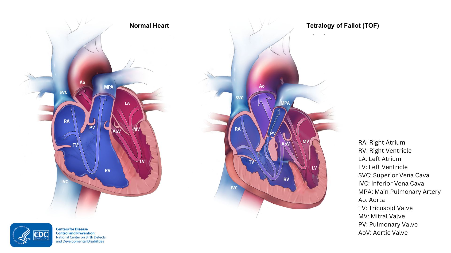 A typical heart compared with Tetralogy of Fallot