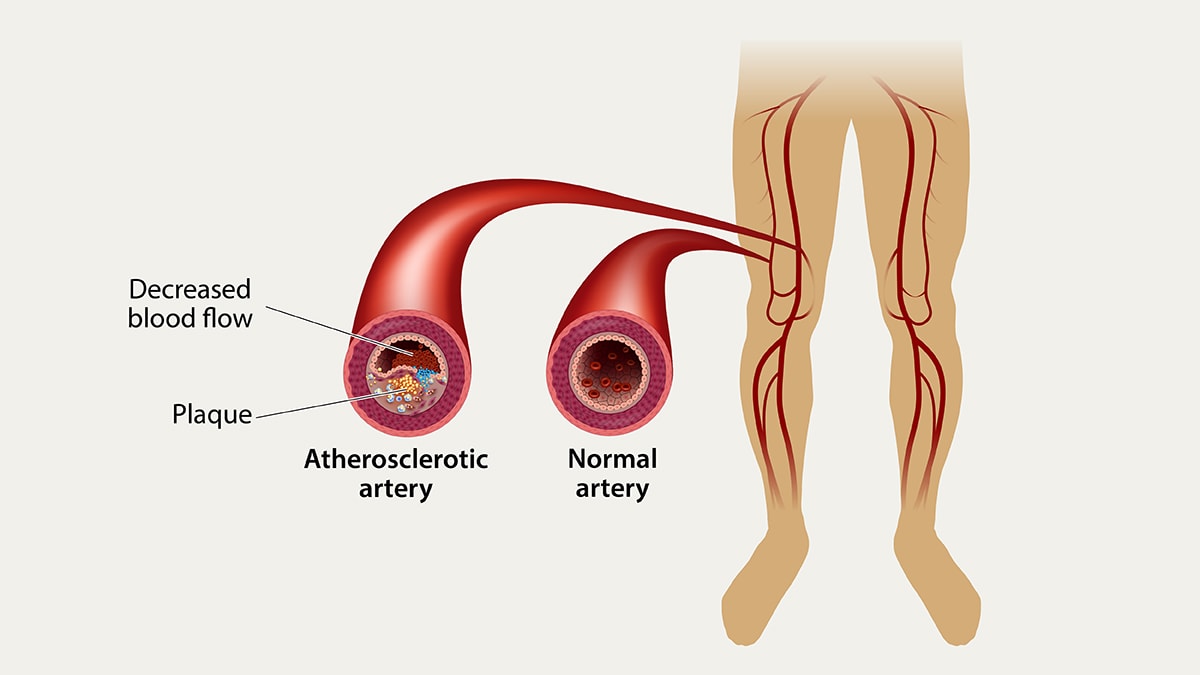 An illustration of the arteries in the legs.