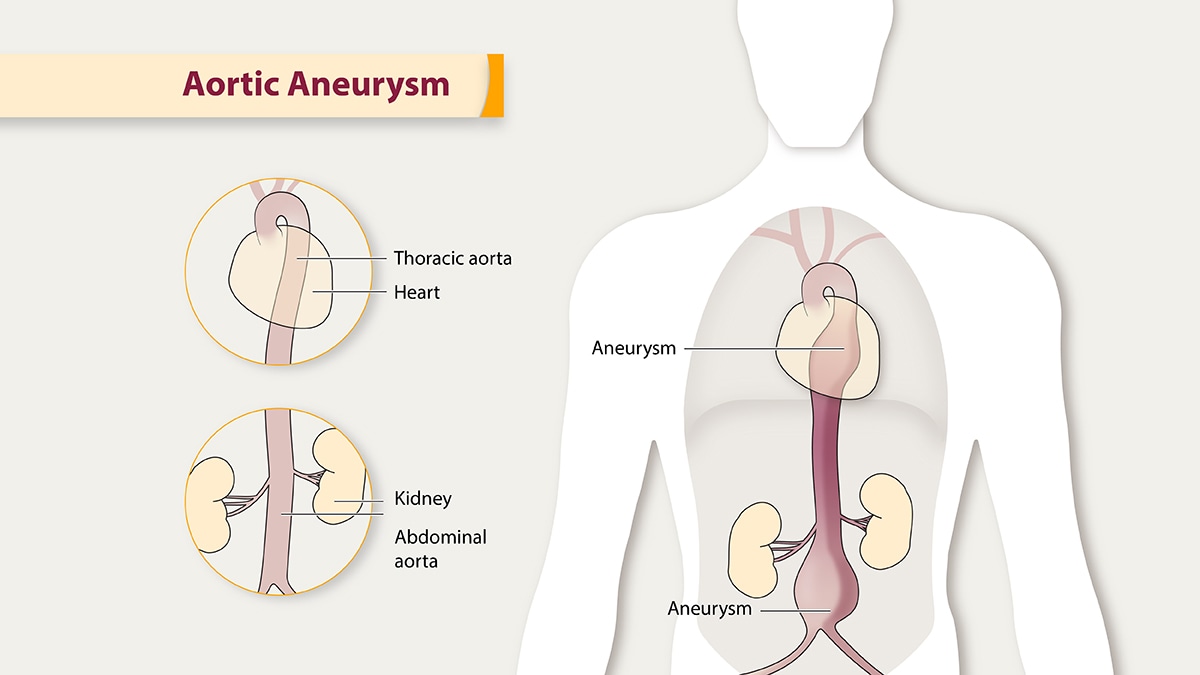 Illustration of an aortic aneurysm.
