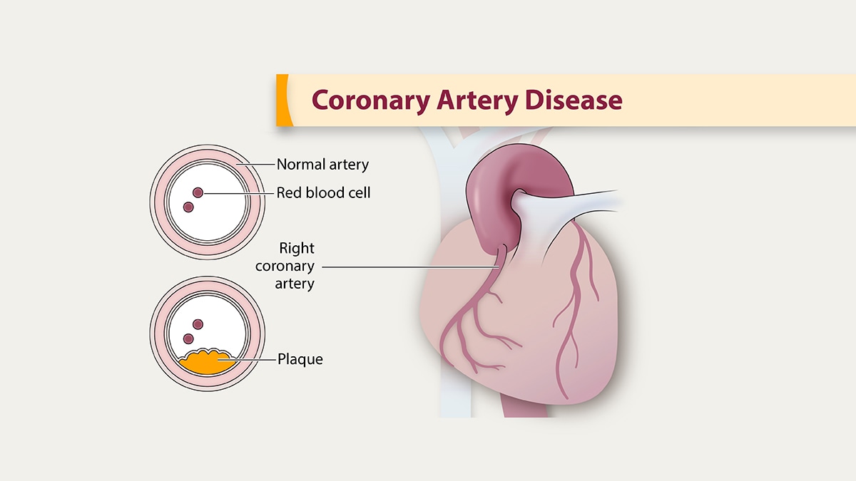 Illustration of coronary artery disease showing plaque build up in the arteries.