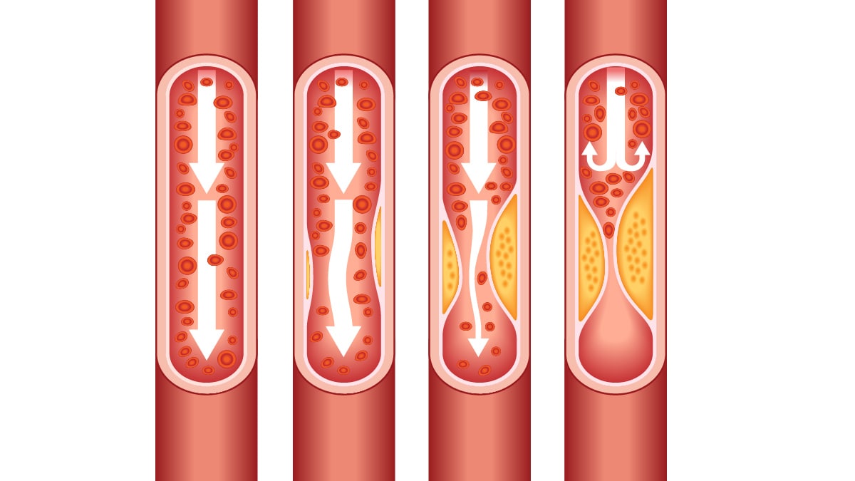 Illustration of plaque in the arteries.