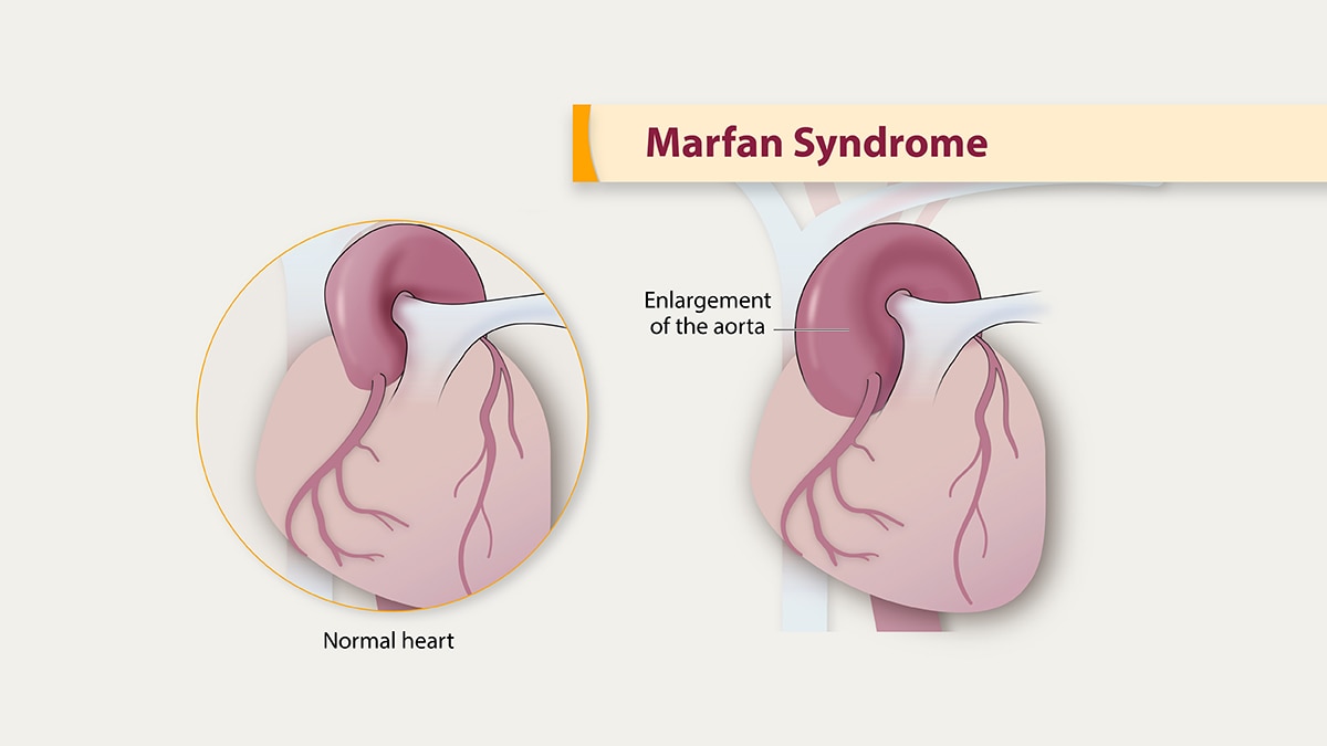Illustration of the heart and the aorta, showing how the aorta is enlarged with Marfan syndrome.