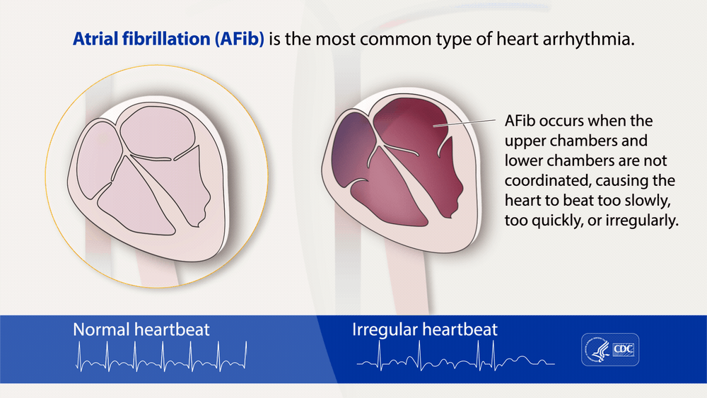 Atrial Fibrillation (AFib) is the most common type of heart arrhythmia. AFib occurs when the upper chambers and lower chambers of the heart are not coordinated, causing the heart to beat too slowly, too quickly, or irregularly.