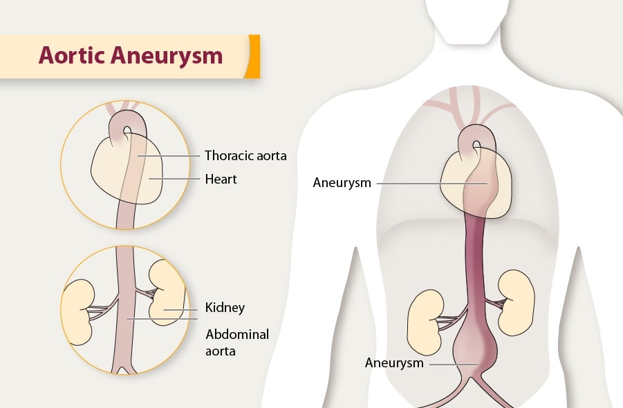 Aortic Aneurysm | cdc.gov