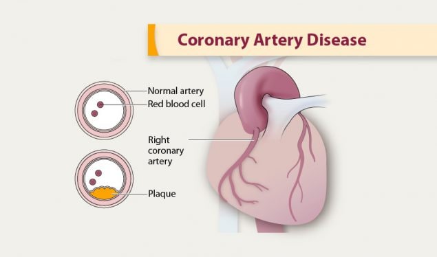 Coronary Artery Disease | cdc.gov