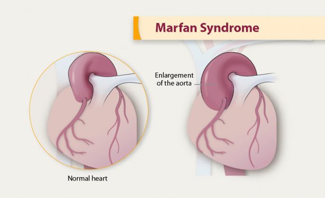 Illustration of Marfan Syndrome.