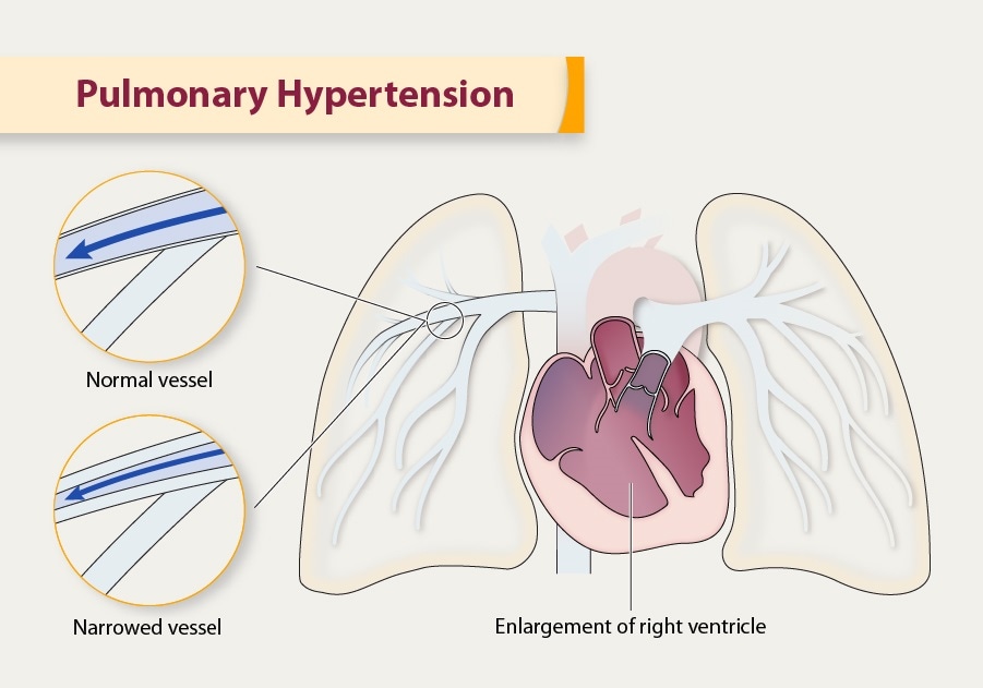 Illustration of pulmonary hypertension in the heart.