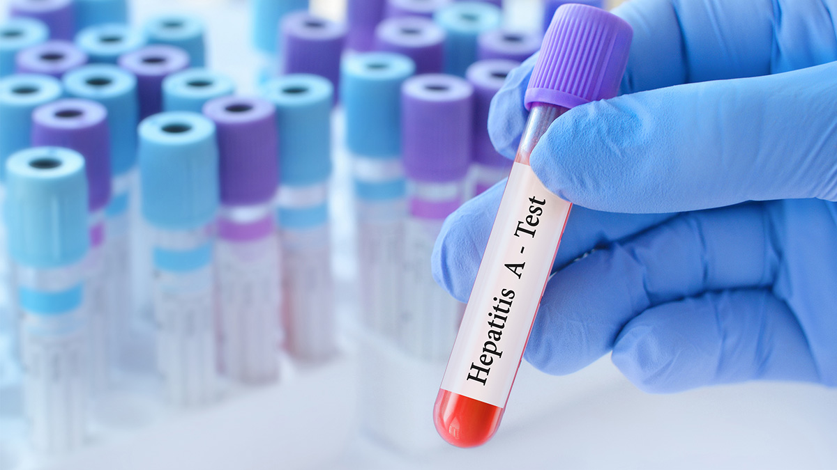 A medical sample in a test tube that is labelled "Hepatitis A Test"