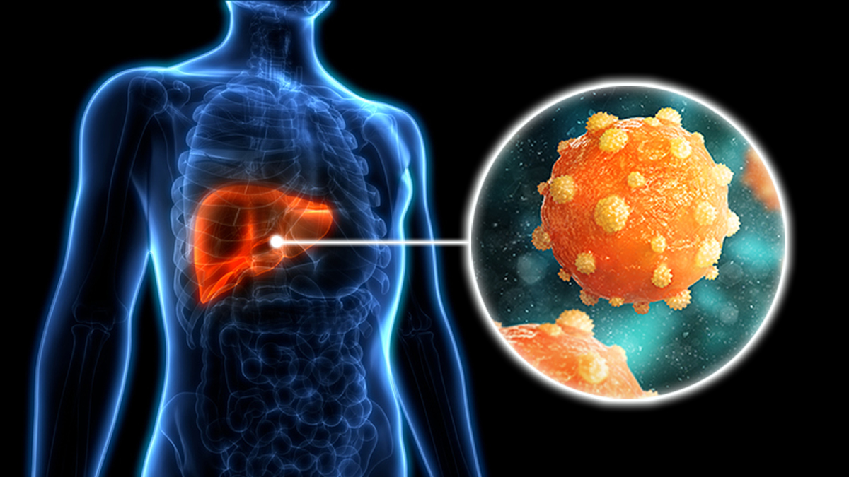 Hepatitis B Basics | Hepatitis B Hepatitis B Basics | Hepatitis B