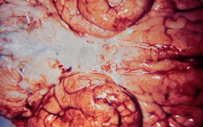 Bottom portion of a brain infected with Gram-negative Haemophilus influenzae bacteria.