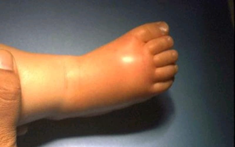 Haemophilus influenzae type b. Cellulitis of the foot proven by blood culture.