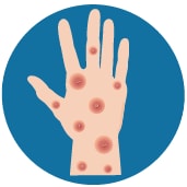 icon for monkey pox