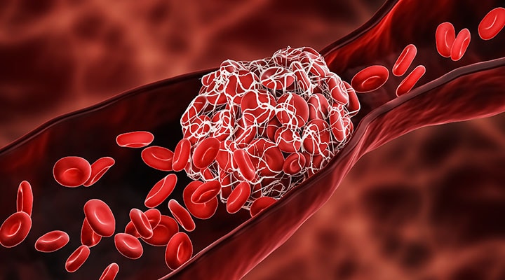 Illustration of blood clot blocking the red blood cells stream