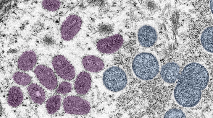 Imagen microscópica en colores de la viruela del mono