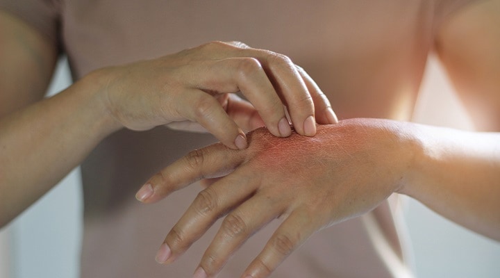 A woman scratching at her inflamed, itchy hand