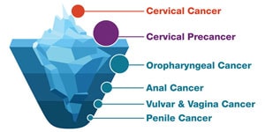 HPV cancers are preventable