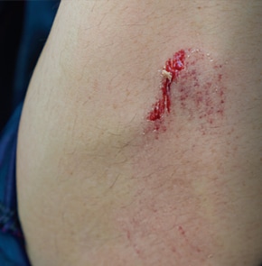 Closeup of blood on scratched skin.