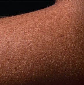 Closeup of skin on person's arm.