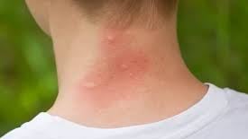 Mosquito bites on the back of a person's neck