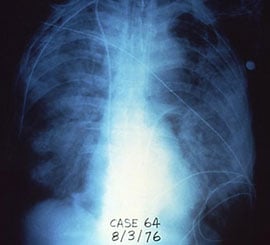 Radiografía del pecho