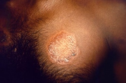 A large, discolored lesion on the chest of a person with Hansen’s disease.