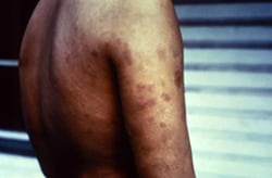 patient who had presented to a clinical setting with a case of multibacillary leprosy
