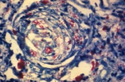 photomicrograph of a skin tissue sample from a patient with leprosy shows a cutaneous nerve
