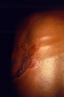 Enlarged nerves below the skin and dark reddish skin patch overlying the nerves affected by the bacteria on the chest of a patient with Hansen’s disease. This skin patch was numb when touched.