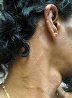 Visible enlargement of the great auricular nerve due to infection