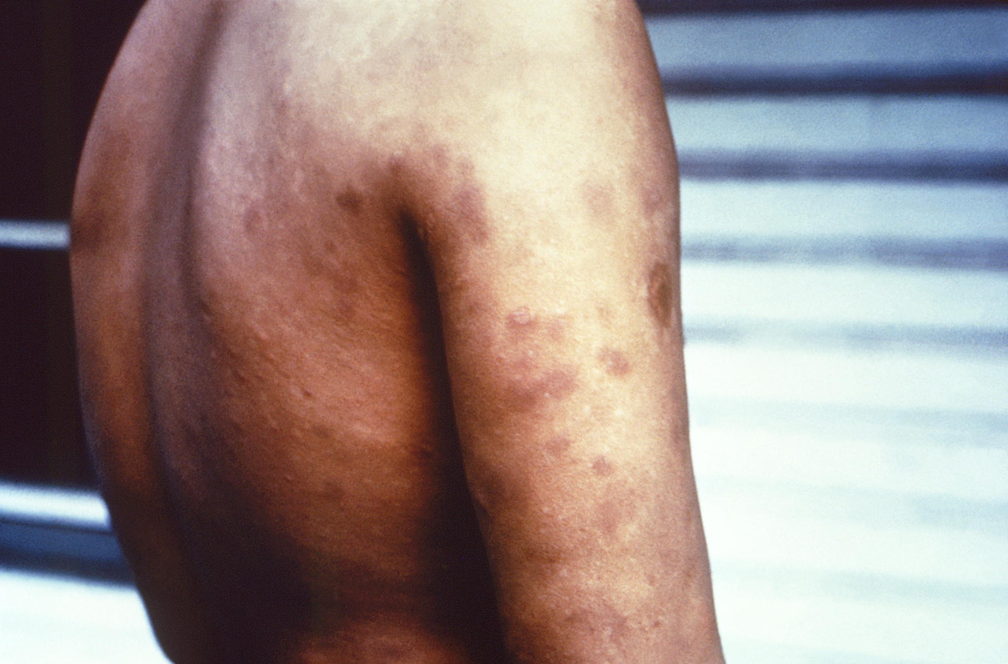Hansen's disease lesions on a person's back and arms
