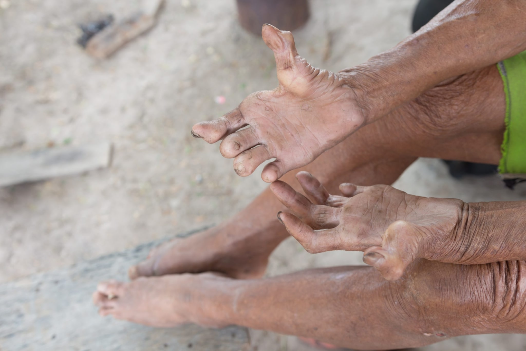 A person with untreated Hansen's disease shows their hands and feet.