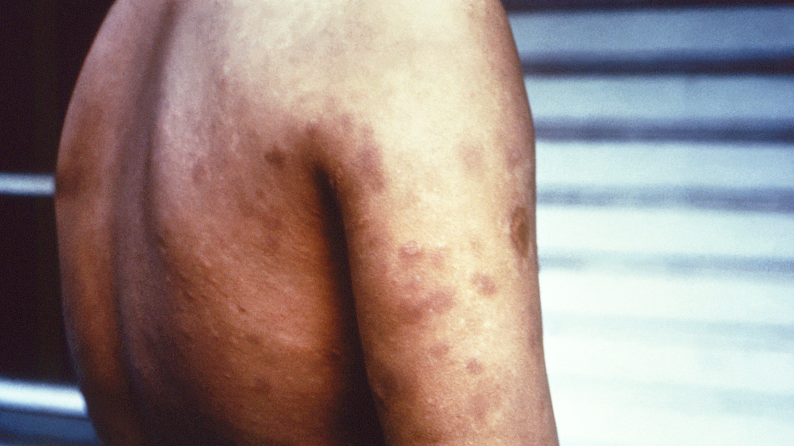 Signs And Symptoms Of Leprosy Leprosy Hansen s Disease CDC signs-and-symptoms-of-leprosy-leprosy-hansen-s-disease-cdc