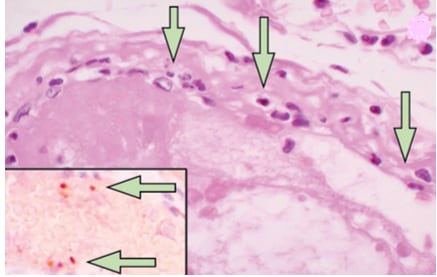 Small intestine. Arrows in main image point to mononuclear(inflammatory) cells within the endothelium of many blood vessels. Inset shows proteins associated with endothelial cell death (caspase 3).