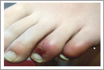 Figure 2: A crusting lesion on one toe of a patient with suspected COVID-19 and mild COVID-19 symptoms.