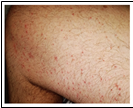 Figure 1: macules and papules of the legs