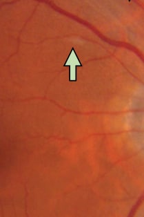 Figure 3 shows cotton wool spots on the retina, present in 4 patients. In all three figures, the light green arrow points to the retinal abnormality