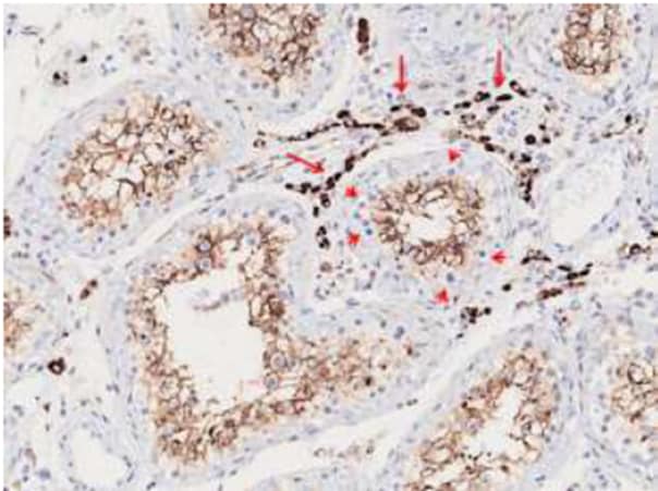 ACE2 cells expressed in Sertoli cells and strongly expressed in Leydig cells (long arrows) according to immunohistochemistry. Spermatogonia are negative (short arrows).