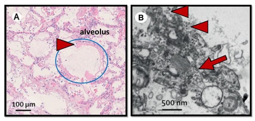 A. Early phase alveolar damage showing thick cellular debris (hyaline membrane; red arrowhead) lining the alveolus (circled in blue).  B. Electron microscope image of virion-like particles inside (red arrow) and along the surface (red arrowheads) of lung cells.