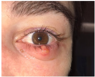 Chalazion of the lower eyelid in a nurse working with patients with COVID-19.