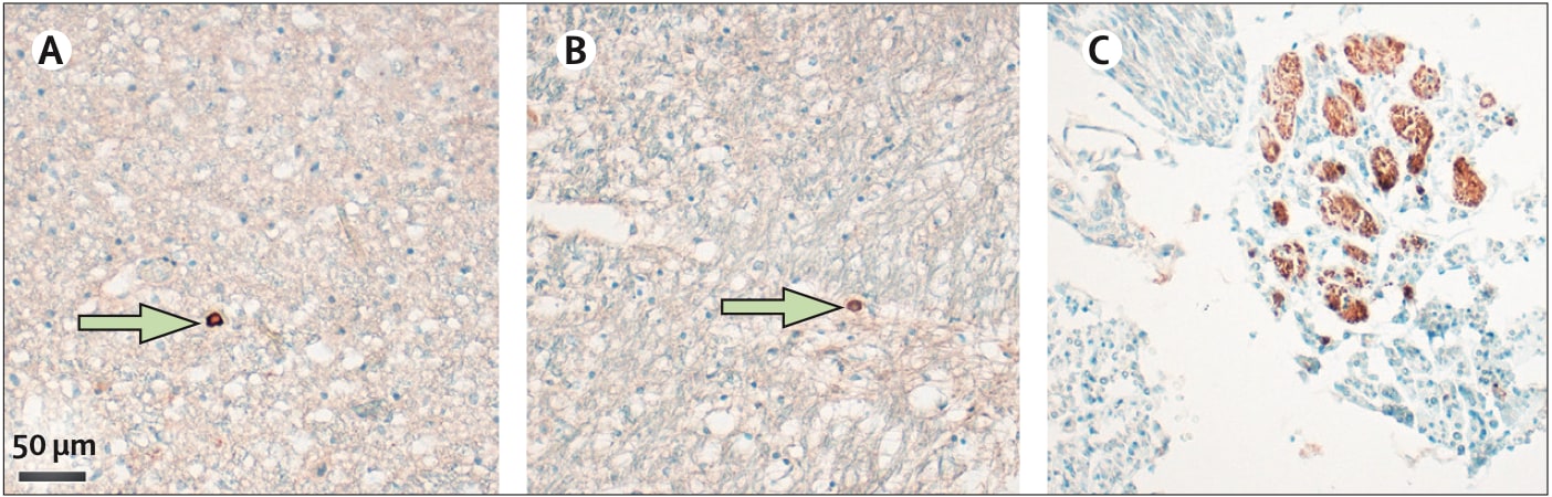 . Viral protein-positive cells (green arrows) in the medulla oblongata detected by anti-nucleocapsid protein antibody (A) or anti-spike protein antibody (B). (C) SARS-CoV-2 nucleoprotein (brown staining) in cranial nerves.