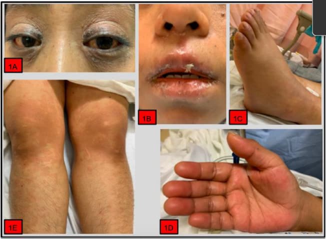 Features of the case including nonexudative conjunctivitis with heliotrope rash (1A), mucositis with cracked lips (1B), extremity edema (1C, 1D), palmar erythema (1D), and diffuse maculopapular rash (1E).