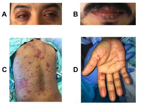 Features of the case including non-exudative conjunctivitis, periorbital edema with overlying erythema (A), lip cheilitis (B), and erythema on back (C), and palms (D).