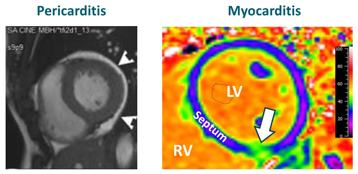 Left panel: White arrows show pericardial effusion in athlete with pericarditis and pericardial effusion. Right panel: Inflammation (white arrow) of the bottom of the wall (septum) dividing the right (RV) and left (LV) cardiac ventricles in athlete with myocarditis.