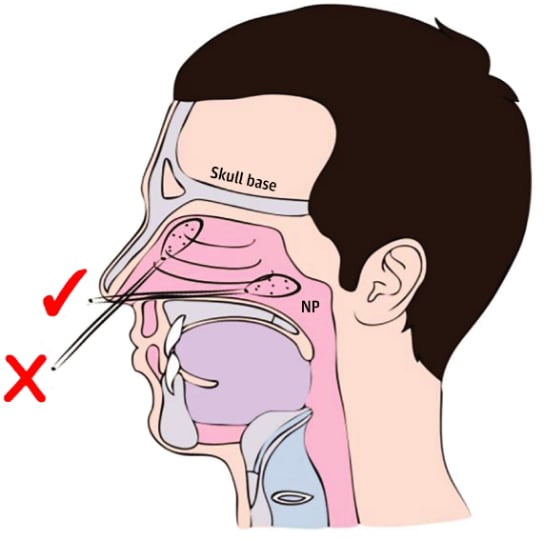 Diagram of nasal anatomy showing the correct (✓) and incorrect (X) trajectory for a swab directed into the nasopharynx (NP). Permission request in process.