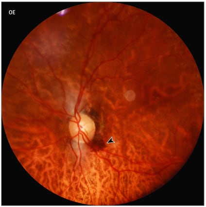 Picture of eye with temporal subretinal hemorrhage