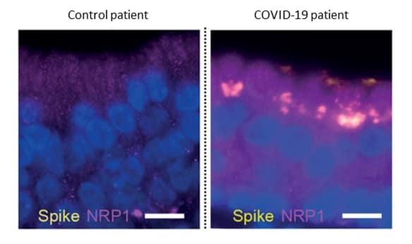 Co-localization of NRP1 and Spike protein in olfactory epithelial cells in a control patient and a COVID-19 patient.