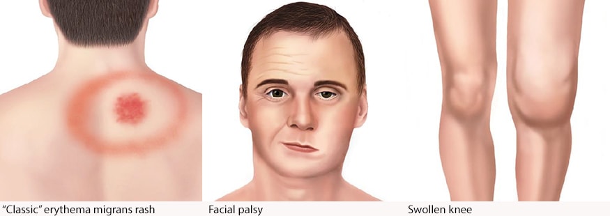 medical illustration of Erythema migrans, medical illustration of Bell's Palsy, and medical illustration of an arthritic knee