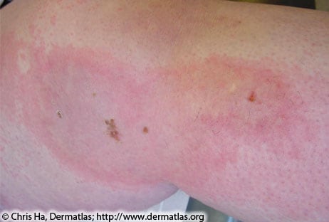 Large red rash on person's leg